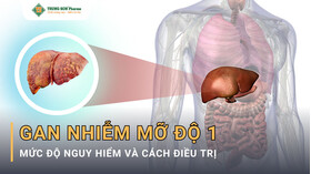 Gan Nhiễm Mỡ Độ 1 Là Gì? Mức Độ Nguy Hiểm Và Cách Điều Trị Gan Nhiễm Mỡ Độ 1 Là Gì? Mức Độ Nguy Hiểm Và Cách Điều Trị
