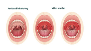 Viêm amidan là gì? Nguyên nhân, triệu chứng và 5 cách điều trị hiệu quả